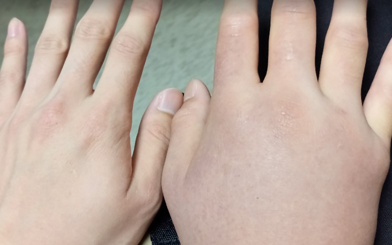 患者左手未曝曬與右手曝曬後比較可見右手背有嚴重的紅腫症狀